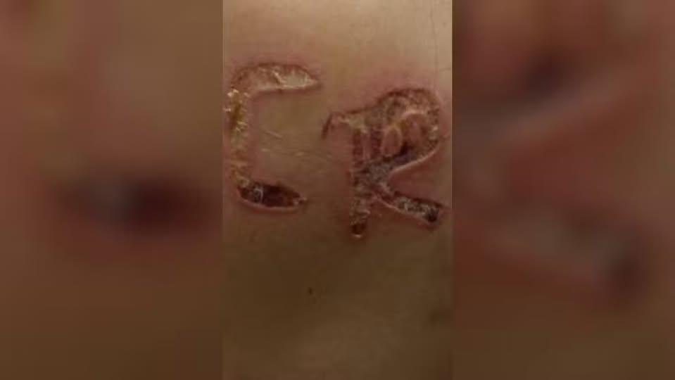 Marido é preso após marcar iniciais do nome dele no corpo da esposa